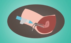 Hysteroscopy-Small-vector